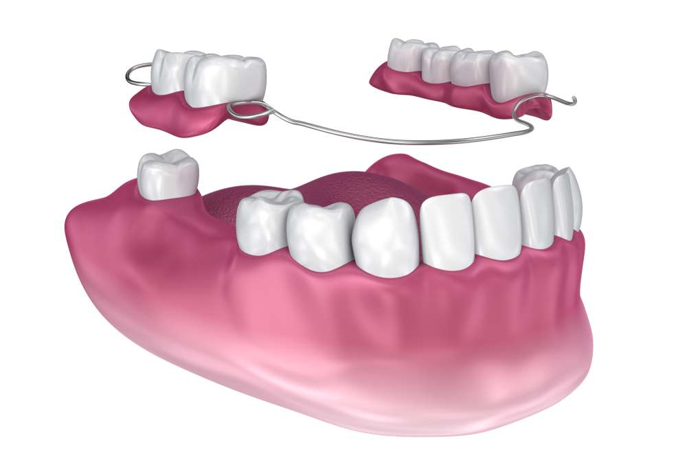 How To Make A Partial Denture?