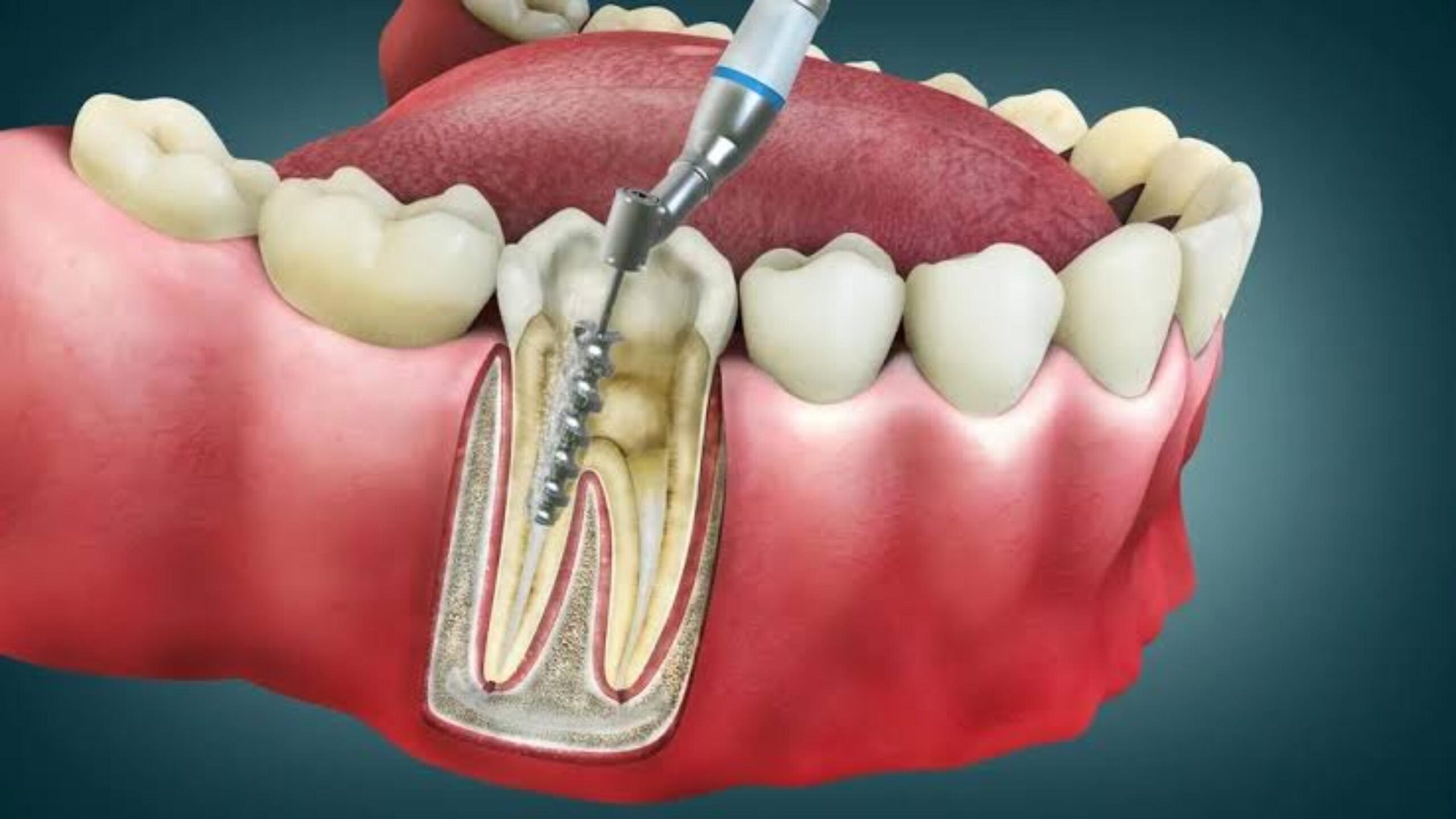 How Long does a Root Canal Last without a Crown